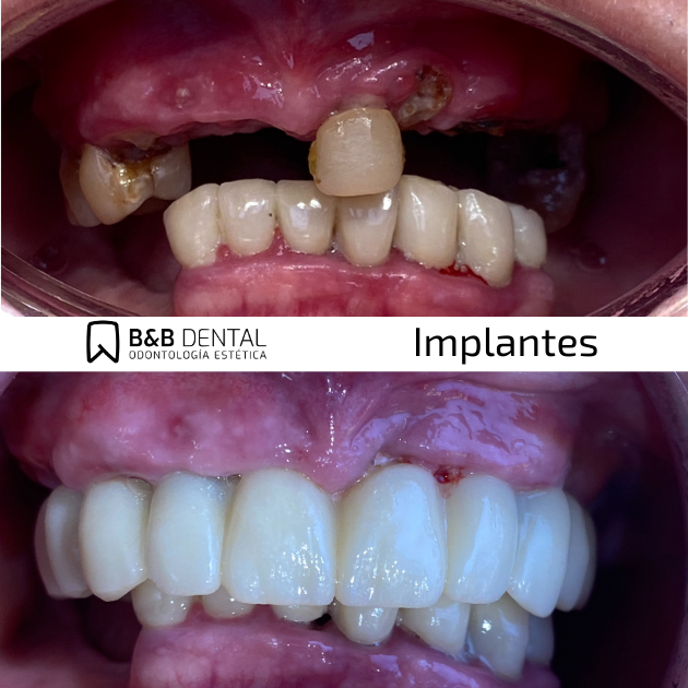 Endodoncia Málaga