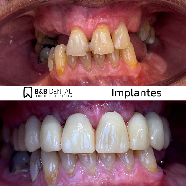 Endodoncia Málaga