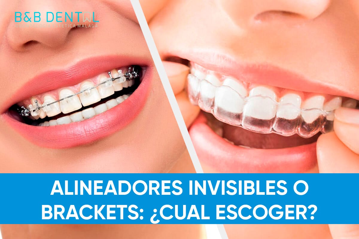 INVISALIGN VS BRACKETS Blog