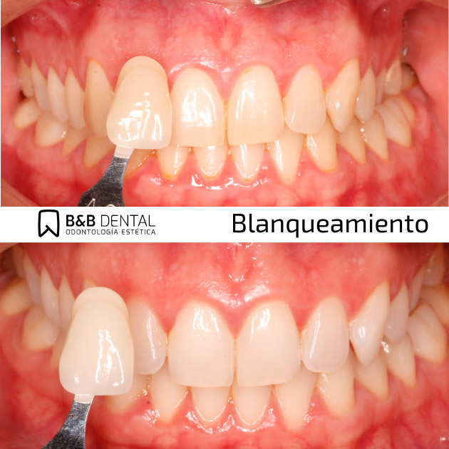 Teeth Whitening in Malaga
