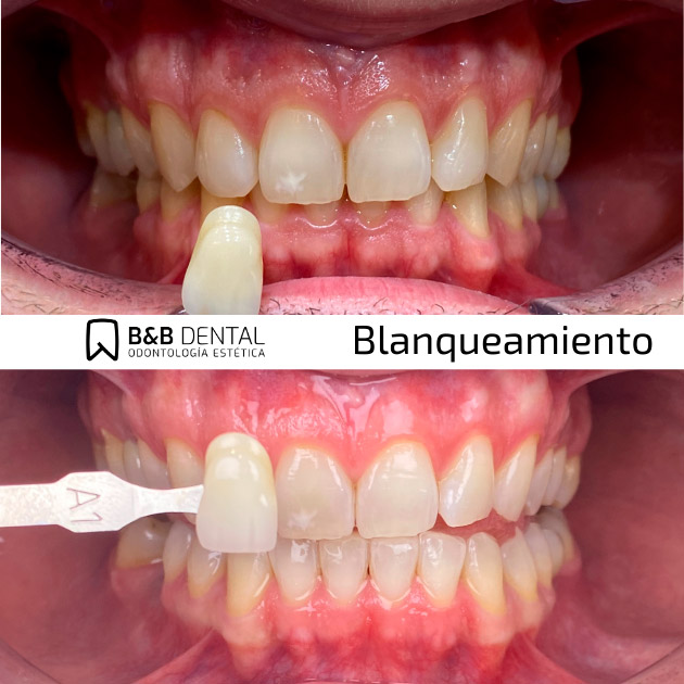 Teeth Whitening in Malaga