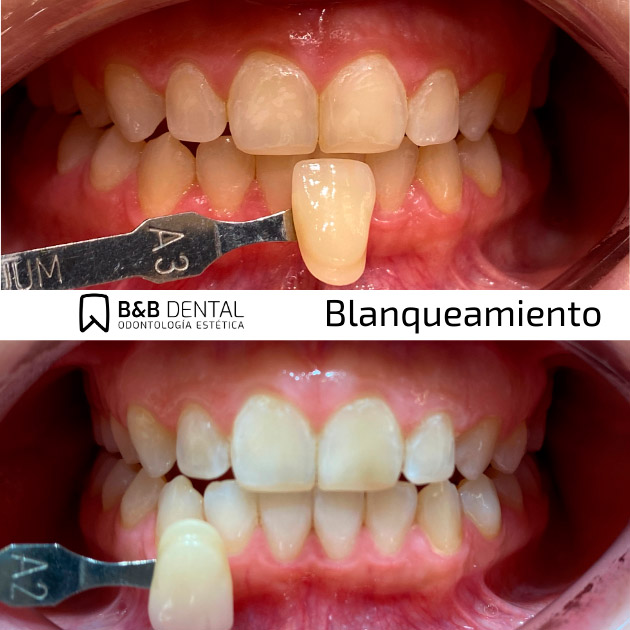 Teeth Whitening in Malaga