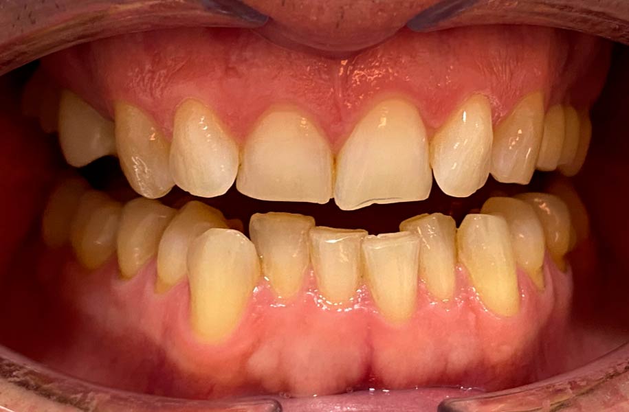 Invisible Braces Malaga