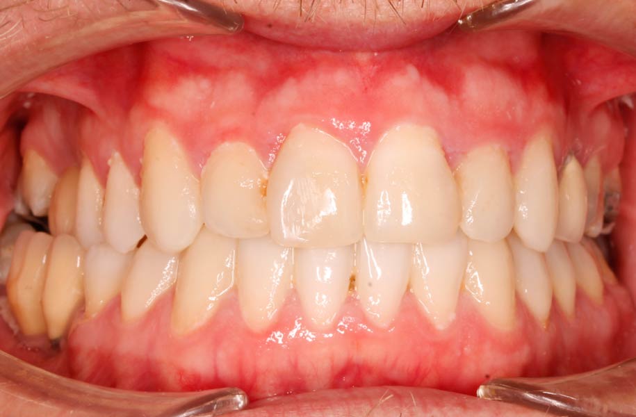 Invisible Braces Malaga