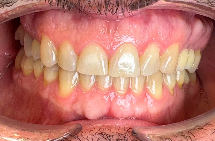Invisible Braces Malaga