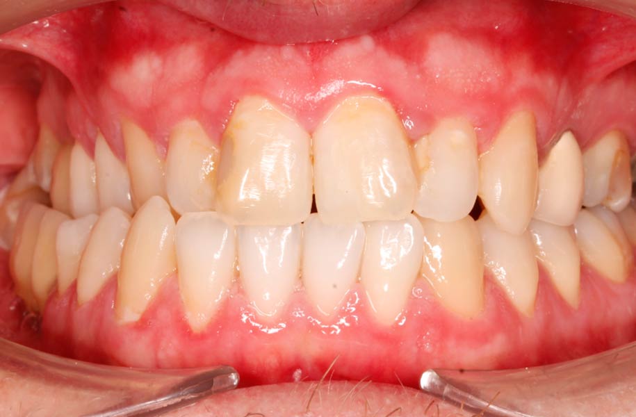 Invisible Braces Malaga