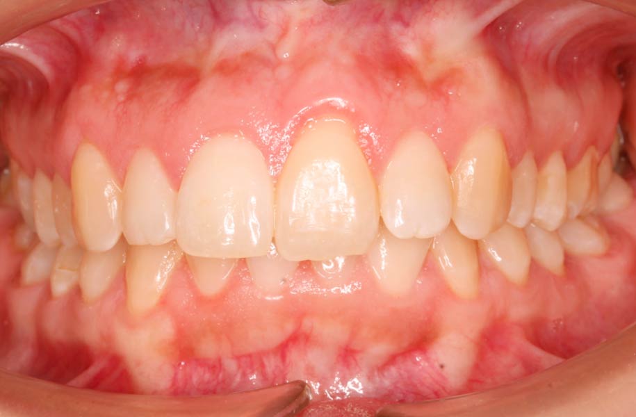 Invisible Braces Malaga