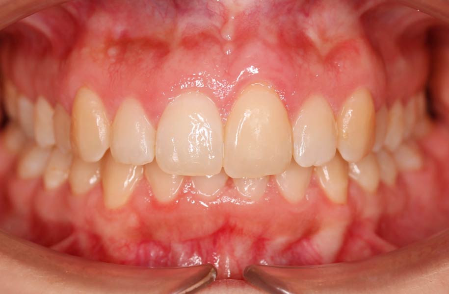 Invisible Braces Malaga