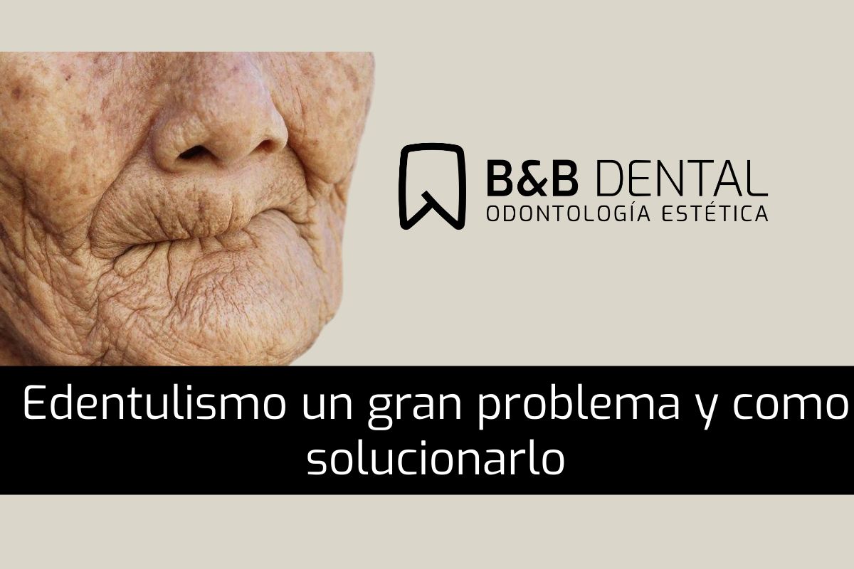 Edentulismo un gran problema y como solucionarlo Problemas de no tener dientes