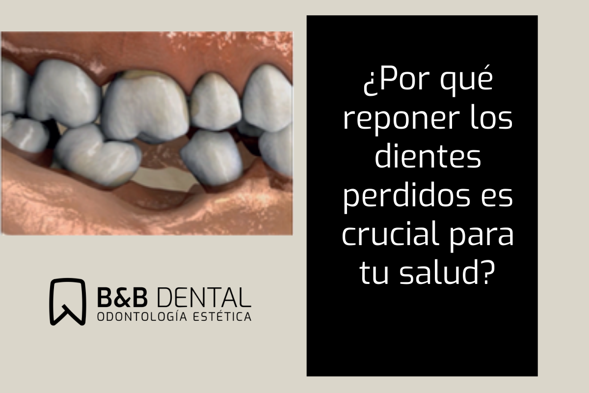Importancia reponer los dientes con implantes dentales malaga Blog