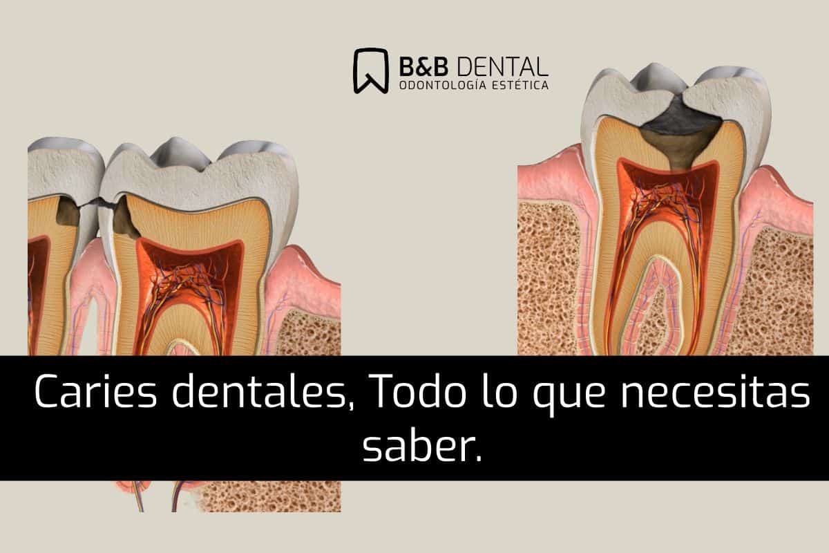 caries dentales todo lo que necesitas seber de la mano del mejor dentista de Malaga Caries dentales en Málaga