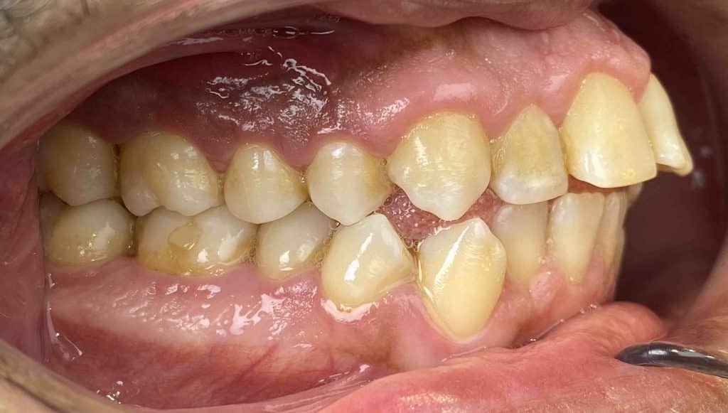 Apinnamiento ortodoncia invisible Malaga Apiñamiento dental: qué es, por qué ocurre y cómo se soluciona
