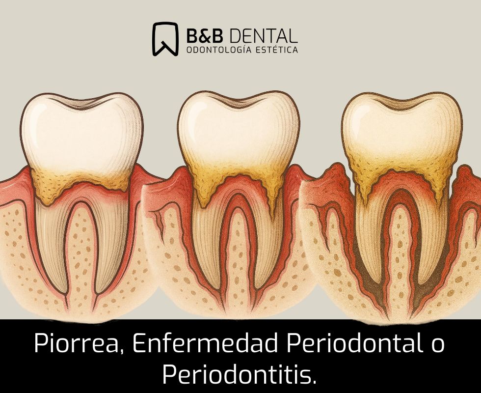 El mejor dentista de Malaga Periodoncia Periodoncia con el mejor dentista de Málaga