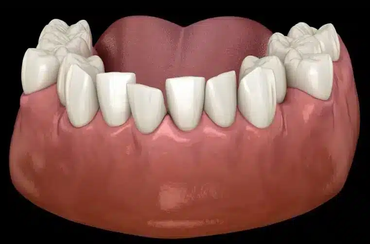 apinamiento dental ortodoncia malaga Apiñamiento dental: qué es, por qué ocurre y cómo se soluciona