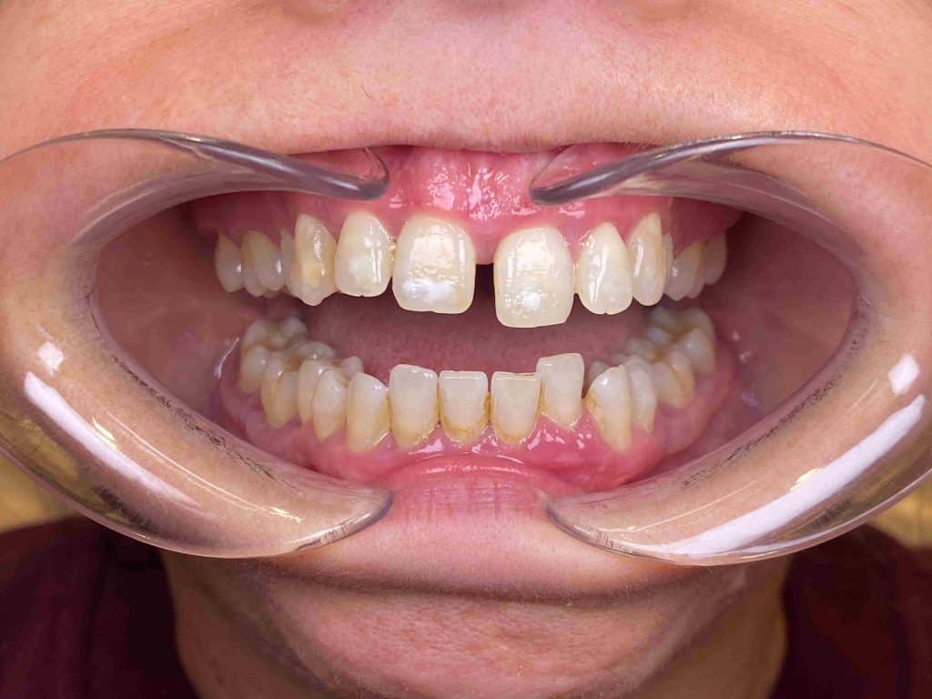 apinamiento ortodoncia adultos Malaga Apiñamiento dental: qué es, por qué ocurre y cómo se soluciona