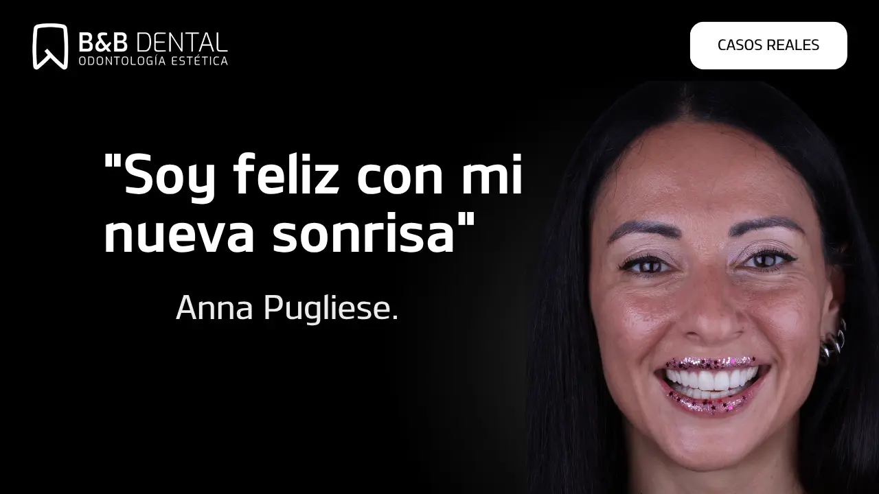 Anna Pugliese, caso de éxito en ByB Dental con su blanqueamiento dental y carillas de composite.