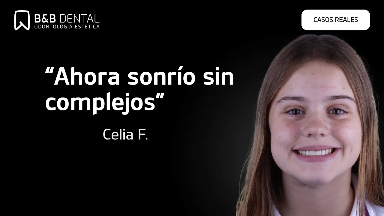 Celia Frankde éxito en ByB Dental con ortodoncia y carillas dentales en Málaga