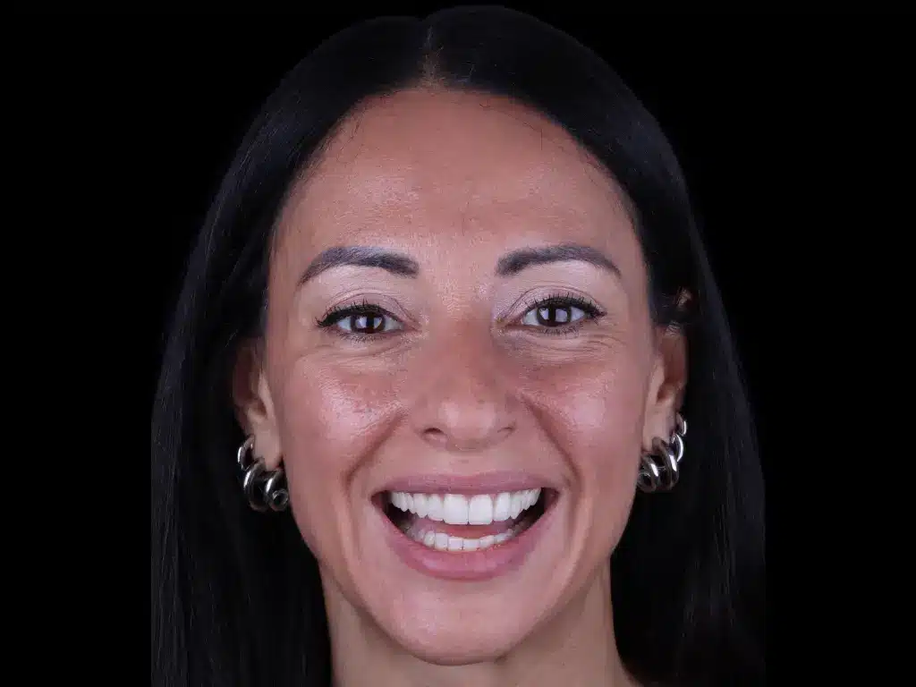 Caso de éxito en ByB Dental - Anna Pugliese en ByB Dental